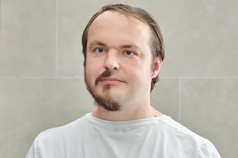 Beard Transplant