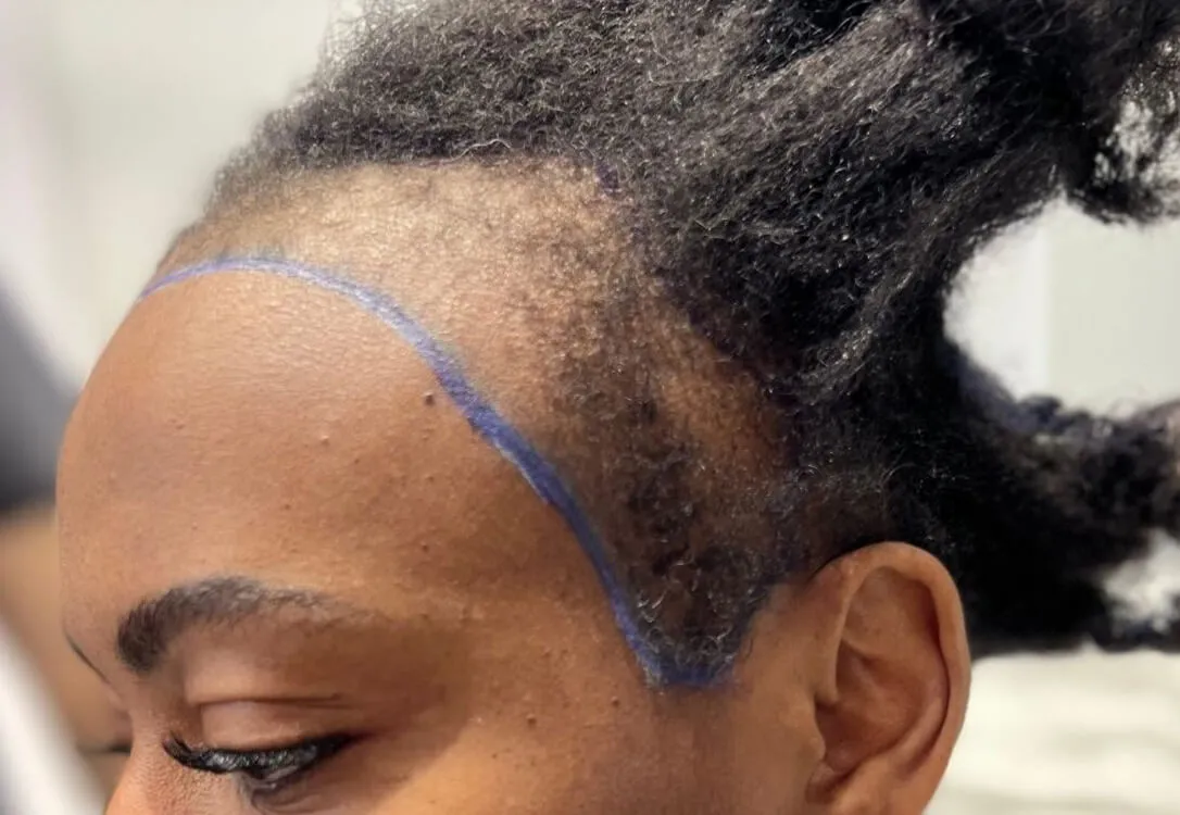 CAN-I-DO-HAIR-TRANSPLANT-WITHOUT-SHAVING.jpg