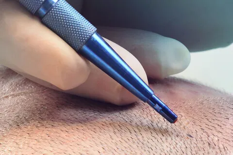 Sapphire-FUE-Technique