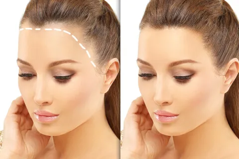 famale-hair-transplant